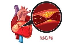 冠心病