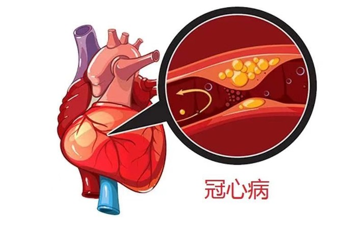 冠心病